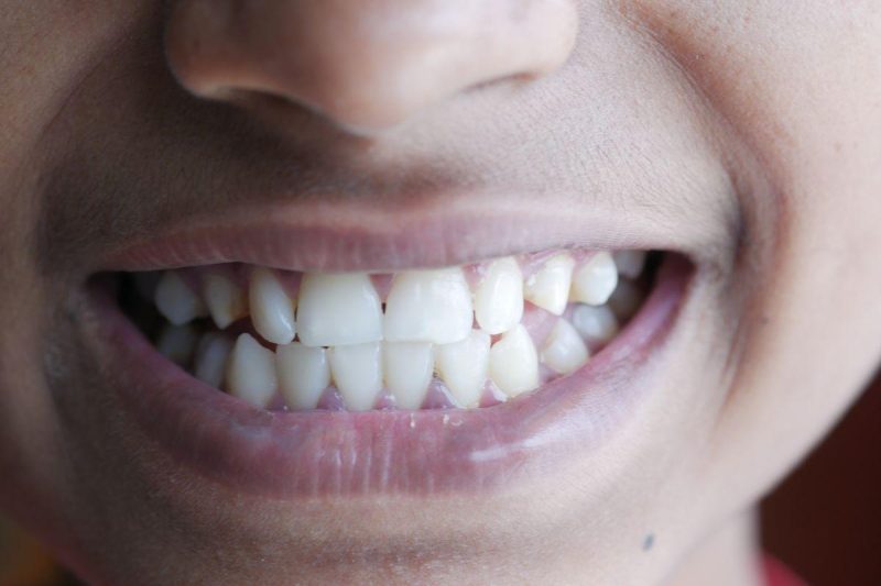 Close-up image of a person with a bright, healthy smile showcasing clean teeth, representing quality dental care